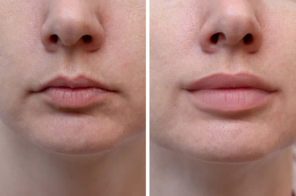 dermal-filler-4.jpg