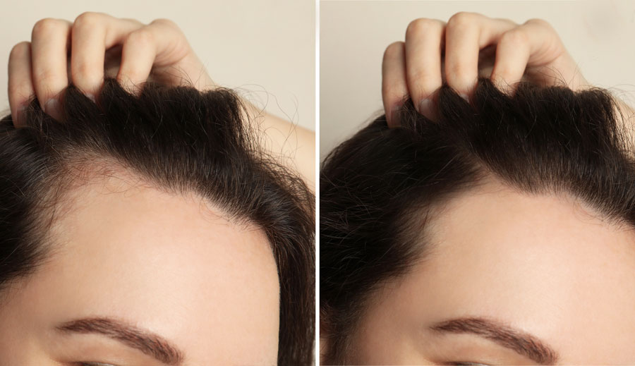 hairloss-therapy-2.jpg