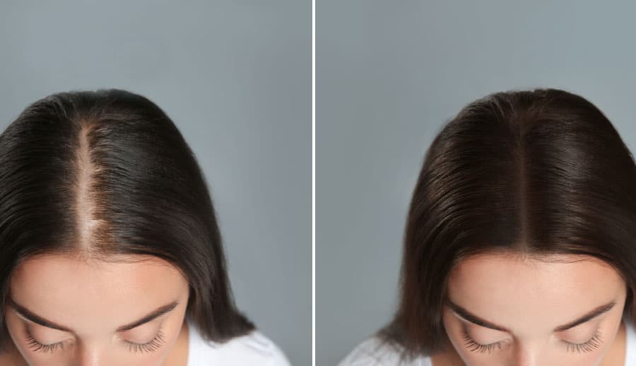 hairloss-therapy-3.jpg