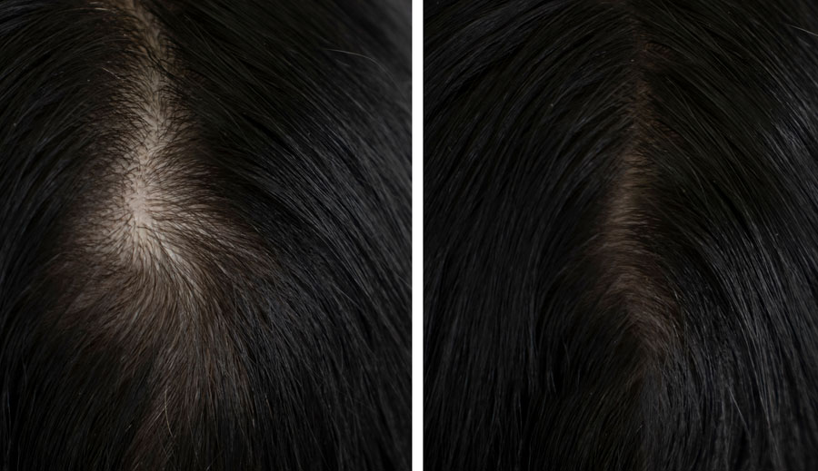 hairloss-therapy-4.jpg